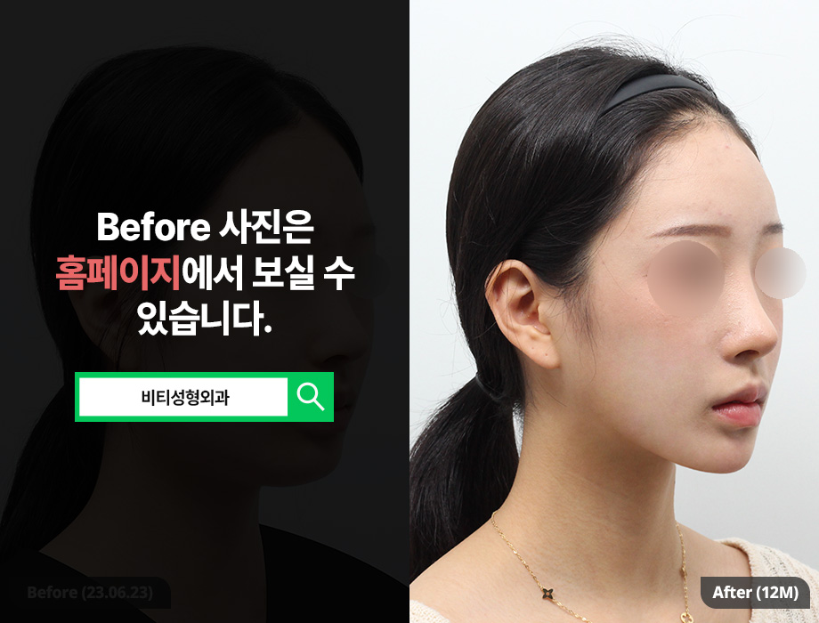 전후차이 확실한 안면윤곽 고려하고 있다면 관련 이미지 2
