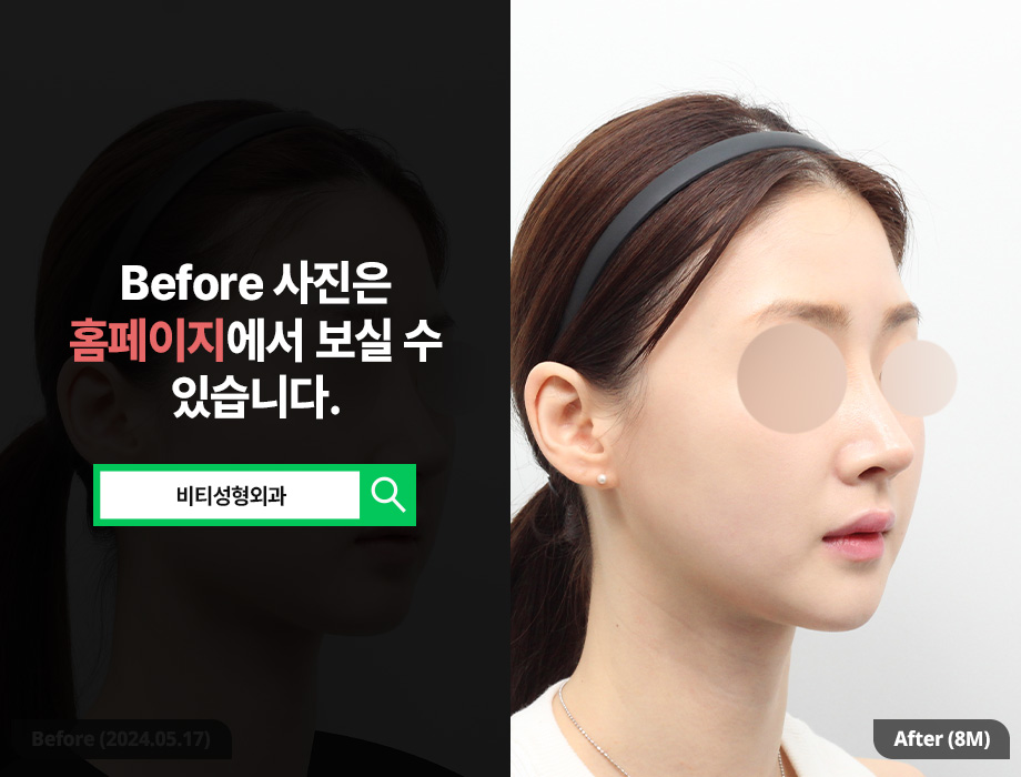 V-line Without T-Osteotomy? The Shocking Secret of Long-Curve Square Jaw Surgery image 2