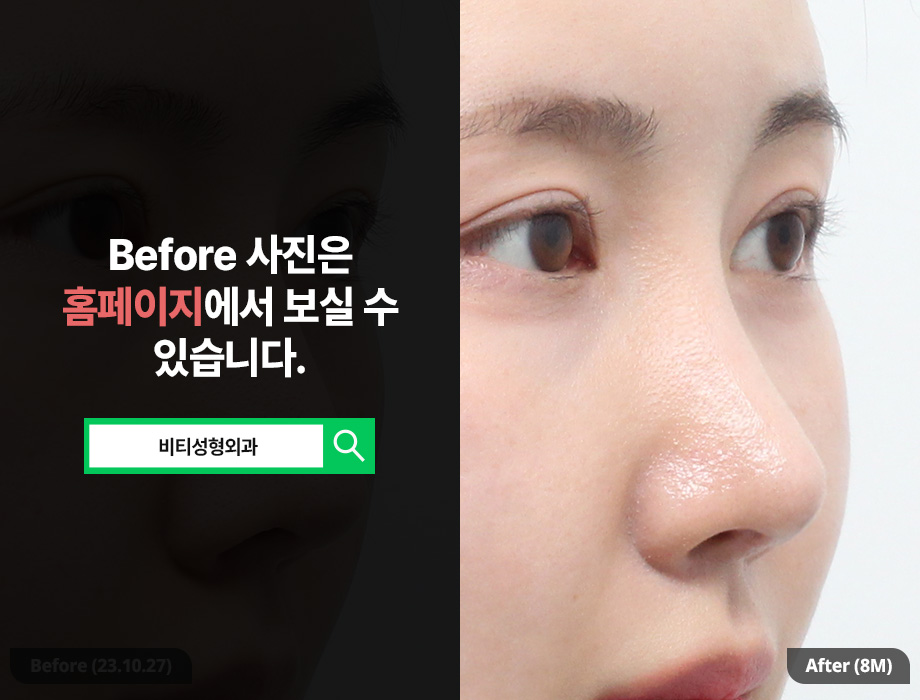 Drooping Nasal Tip.. Do You Really Need Revision Rhinoplasty? image 2