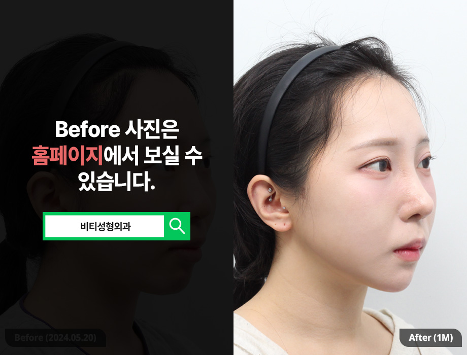 [비티성형외과] 턱끝 필러 vs 윤곽 3종, 현명한 선택 기준 & 후기 관련 이미지 2