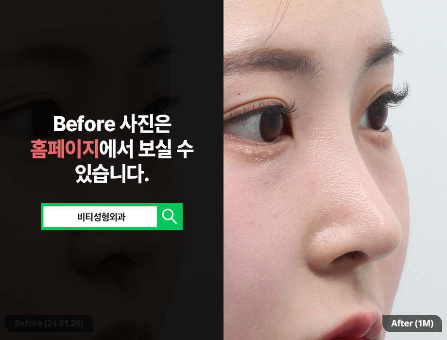 매부리코 복코 필러로는 안되는 이유! 관련 이미지 2