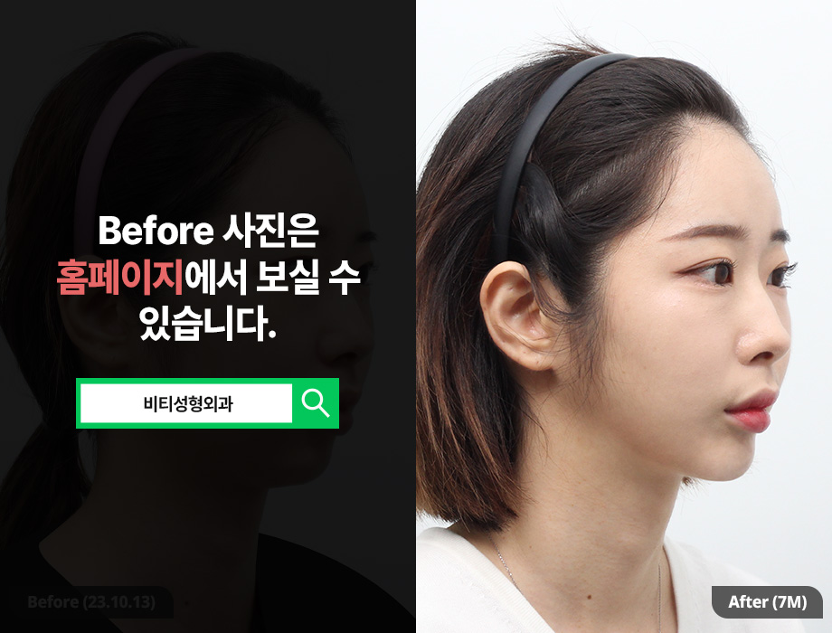 Cheekbone + Square Jaw + Receding Chin Surgery: A Facial Contouring Combination That Balances Face Shape image 2