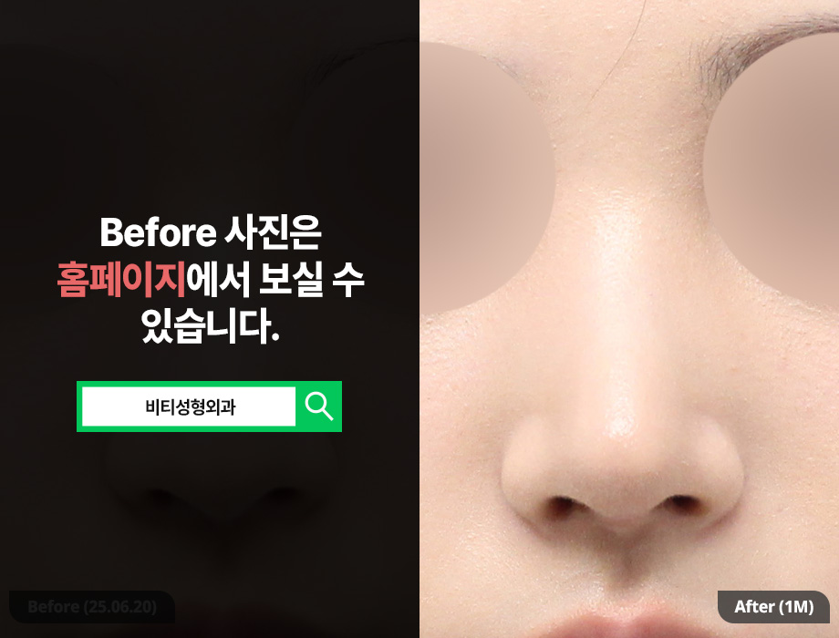 무보형물 코성형 장단점을 확실히 알아보고 관련 이미지 3