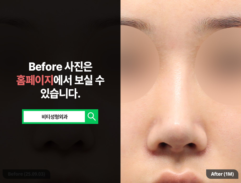 Silicone vs. Rib Cartilage? The Perfect Combination for Rhinoplasty Revision You Won’t Regret Even 10 Years Later image 3