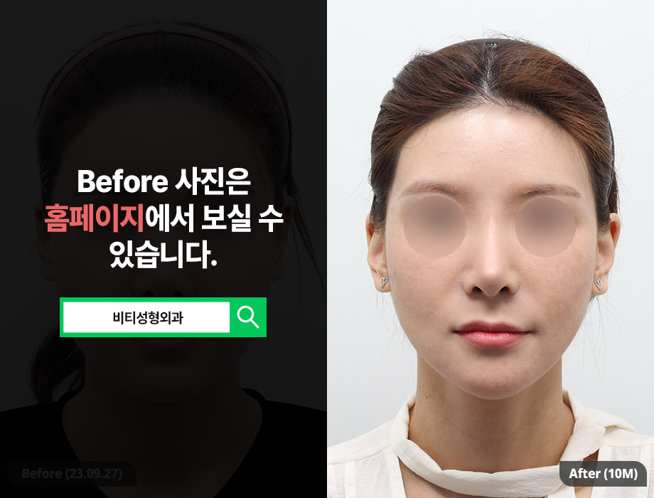 사각턱&턱끝 수술 후기｜윤곽 2종으로 갸름해진 얼굴 Before & After 관련 이미지 1
