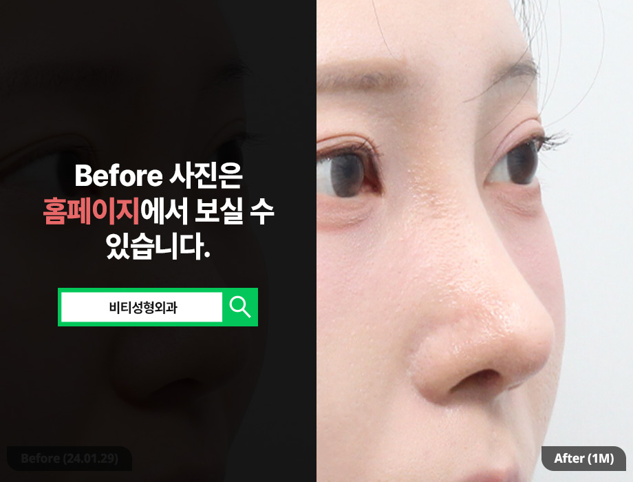 Can donated rib cartilage nose surgery improve a bulbous nose and the nasolabial angle, too? image 2