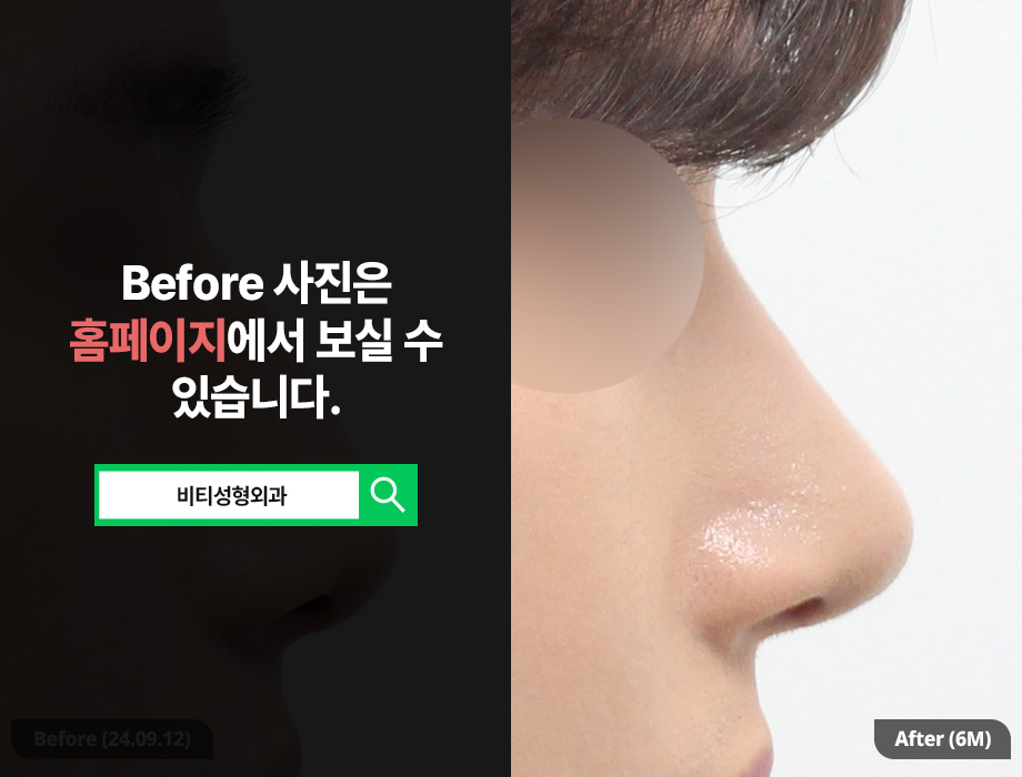 [남자 코성형] 무보형물 코성형이 뜨는이유? 관련 이미지 1