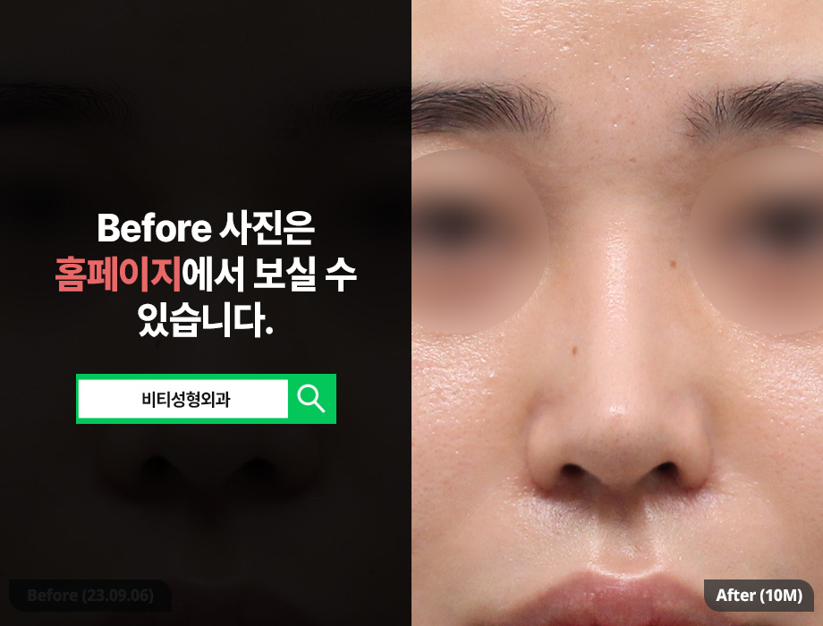 코 재수술, 왜 기증늑 연골이 필요한가? 복코, 콧볼까지 한 번에 해결! 관련 이미지 3
