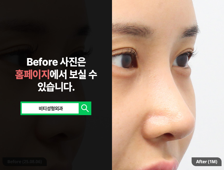 Easy breathing, a pretty line as a bonus! Functional-aesthetic rhinoplasty using donated rib cartilage A to Z image 2
