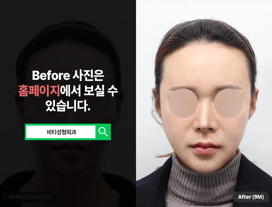 얼굴이 작은데 윤곽수술 해도 되나요? 작고 각진 얼굴 9개월 후기 관련 이미지 1
