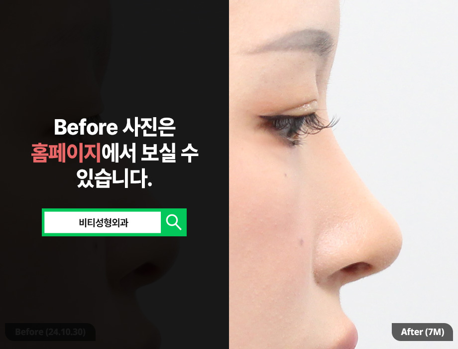 매부리코 + 콧볼축소, 한 번에 수술해야 좋은 이유? 관련 이미지 1