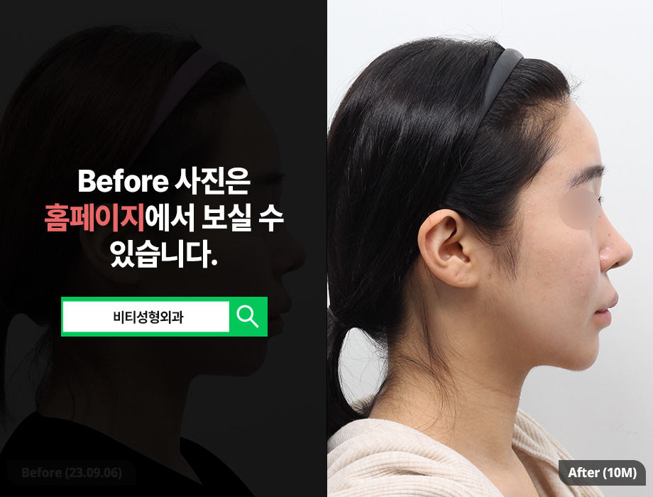 윤곽 3종 수술, 왜 한 번에 받는 걸까? 관련 이미지 3
