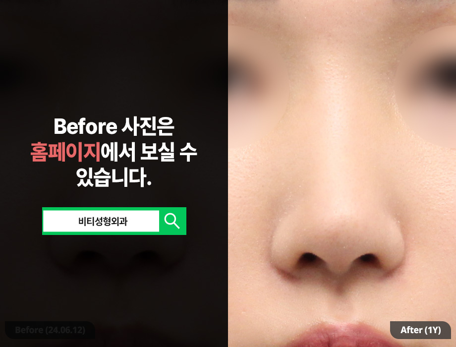 귀연골로 복코 교정 가능한가요? + 코 필러 제거 관련 이미지 3