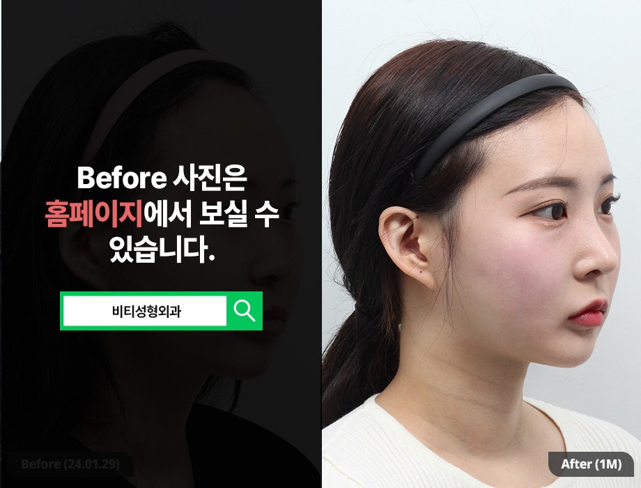 윤곽3종 + 얼굴지방흡입, 요즘 트렌드는? 1개월 리얼후기 관련 이미지 2