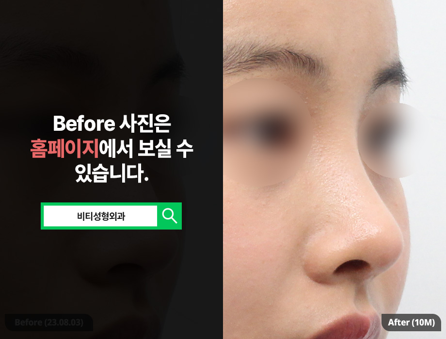 4 Reasons Why It’s Good to Bring Celebrity Photos Before Rhinoplasty image 2