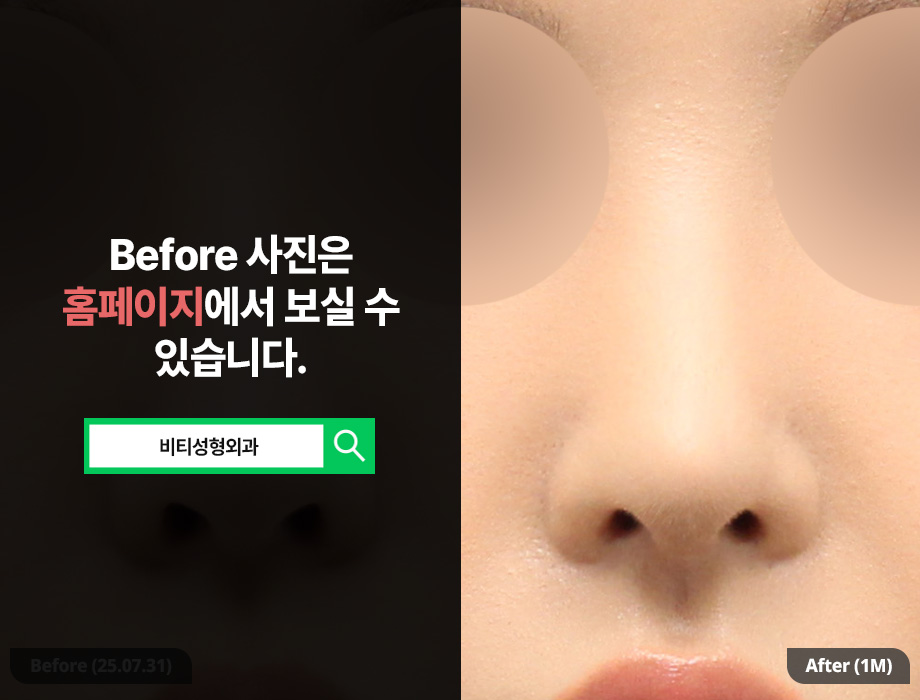 기증늑연골 코 재수술 솔루션 관련 이미지 3