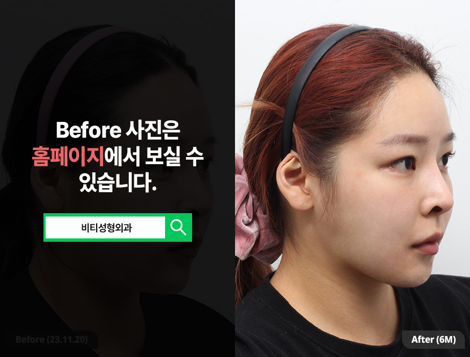 What Changes Can You Expect from Two-Procedure Facial Contouring: Cheekbone + Square Jaw? image 2