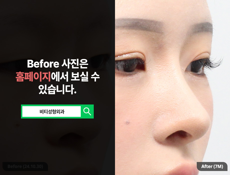 매부리코 + 콧볼축소, 한 번에 수술해야 좋은 이유? 관련 이미지 2
