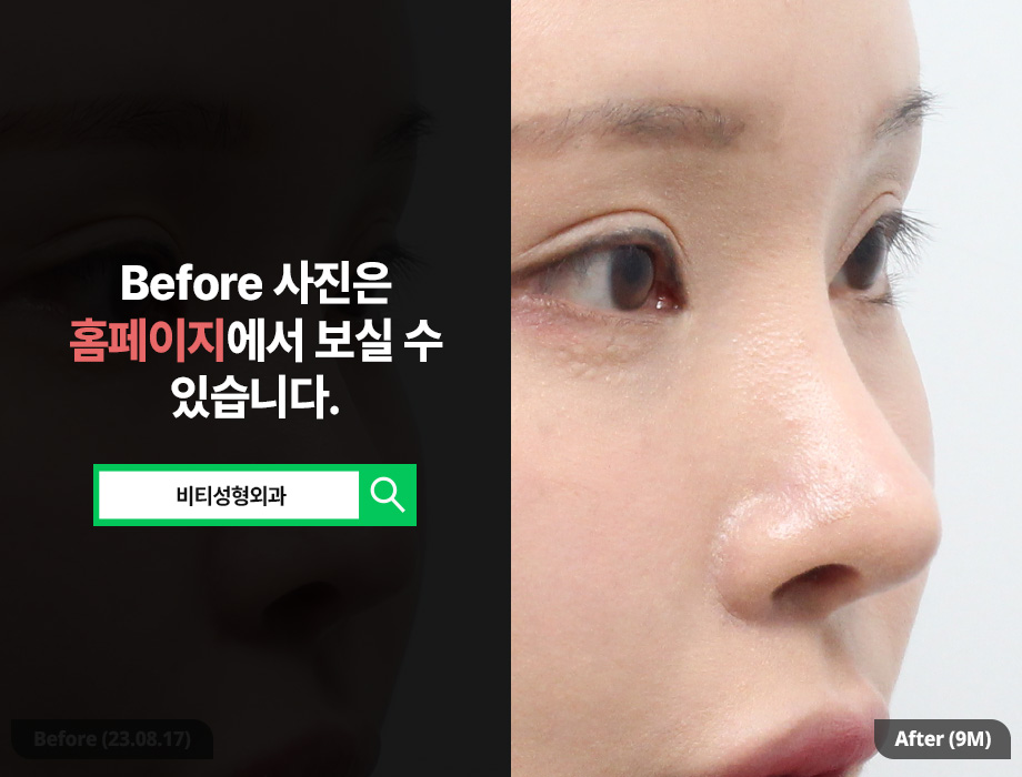 코재수술, 왜 자가늑연골을 사용할까? 관련 이미지 2