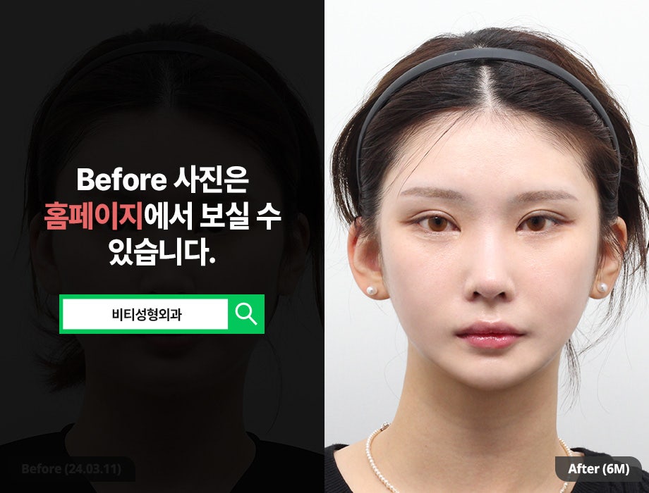 나에게 딱 맞춘 안면윤곽, 비티 퍼스널 라인🫧 관련 이미지 1