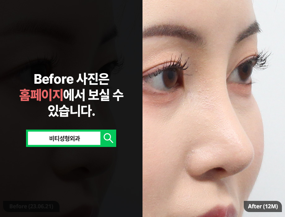 Bulbous Nose Rhinoplasty Is Not Solved by Simply Making It Higher image 2