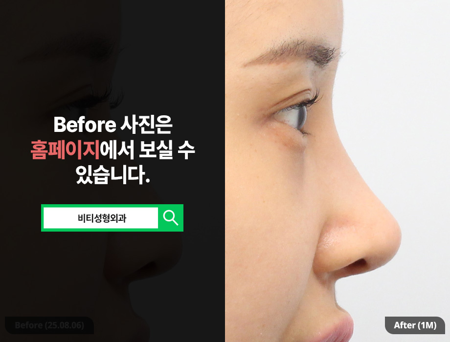 Easy breathing, a pretty line as a bonus! Functional-aesthetic rhinoplasty using donated rib cartilage A to Z image 1