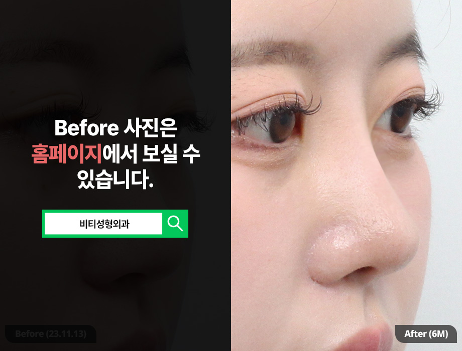귀연골 코성형, 자연스러움을 원한다면? 6개월 리얼후기 관련 이미지 2