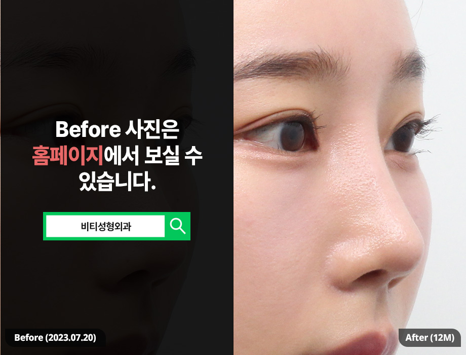 When Is the Most Appropriate Time for Revision Nose Surgery for a Pinched Nose? image 2