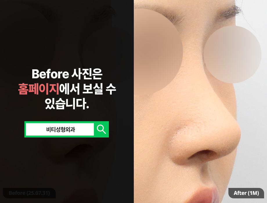 기증늑연골 코 재수술 솔루션 관련 이미지 2