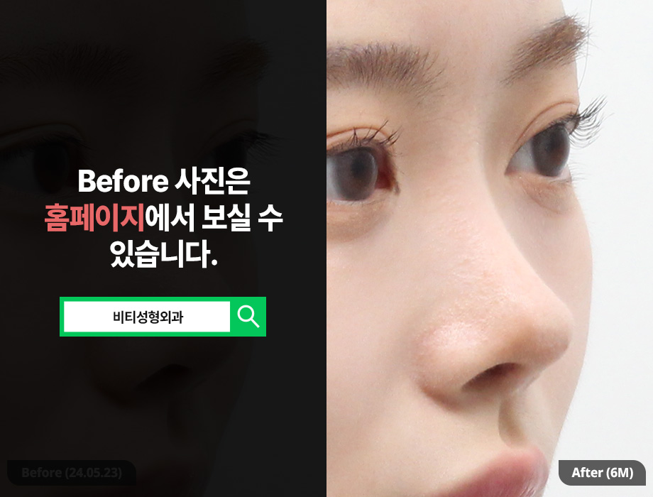 한국에서 코 재수술, 일본인도 찾는 이유? 관련 이미지 2