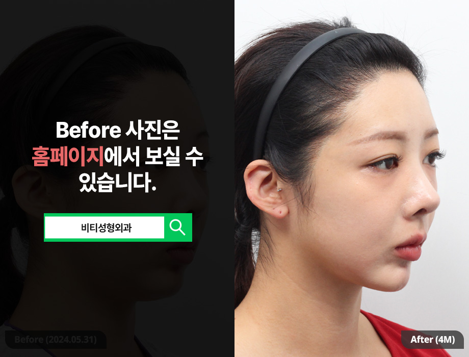 살을 빼도 턱살이 안빠져요 이중턱 근육묶기로 관련 이미지 2