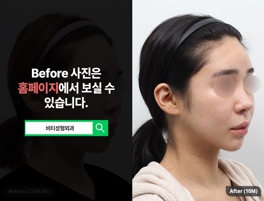 윤곽 3종 수술, 왜 한 번에 받는 걸까? 관련 이미지 2