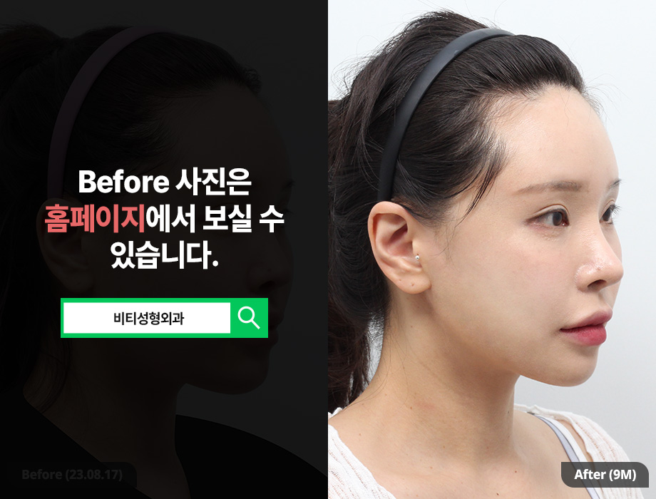 턱 여백 줄이고 작아진 얼굴! 윤곽 3종 리얼후기 관련 이미지 2