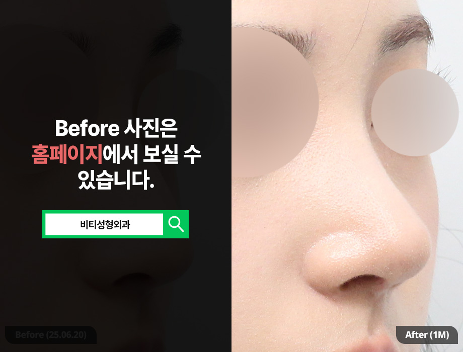 무보형물 코성형 장단점을 확실히 알아보고 관련 이미지 2