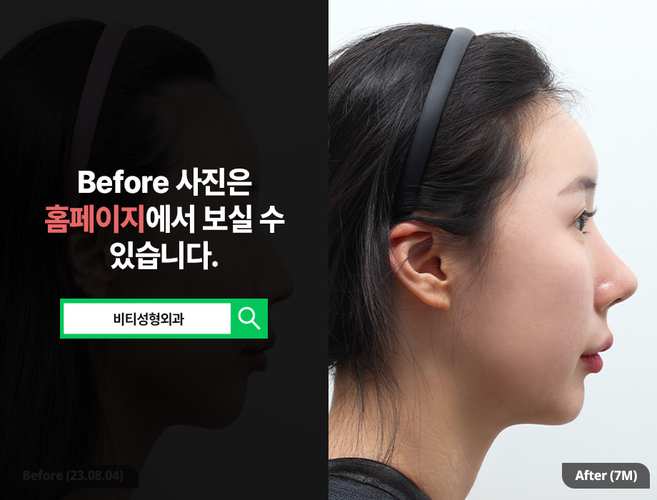 안면윤곽으로 입체감까지 챙기는 "무턱 교정" 관련 이미지 3