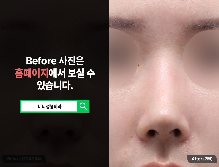 기증늑연골로 무보형물 매부리코 수술, 안전하고 자연스럽게 관련 이미지 3