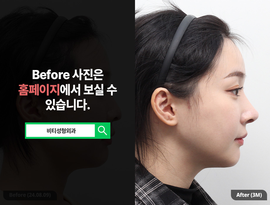 What Should You Check When Considering Facial Contouring Surgery? • A Real 3-Month Review of Contouring Surgery image 3