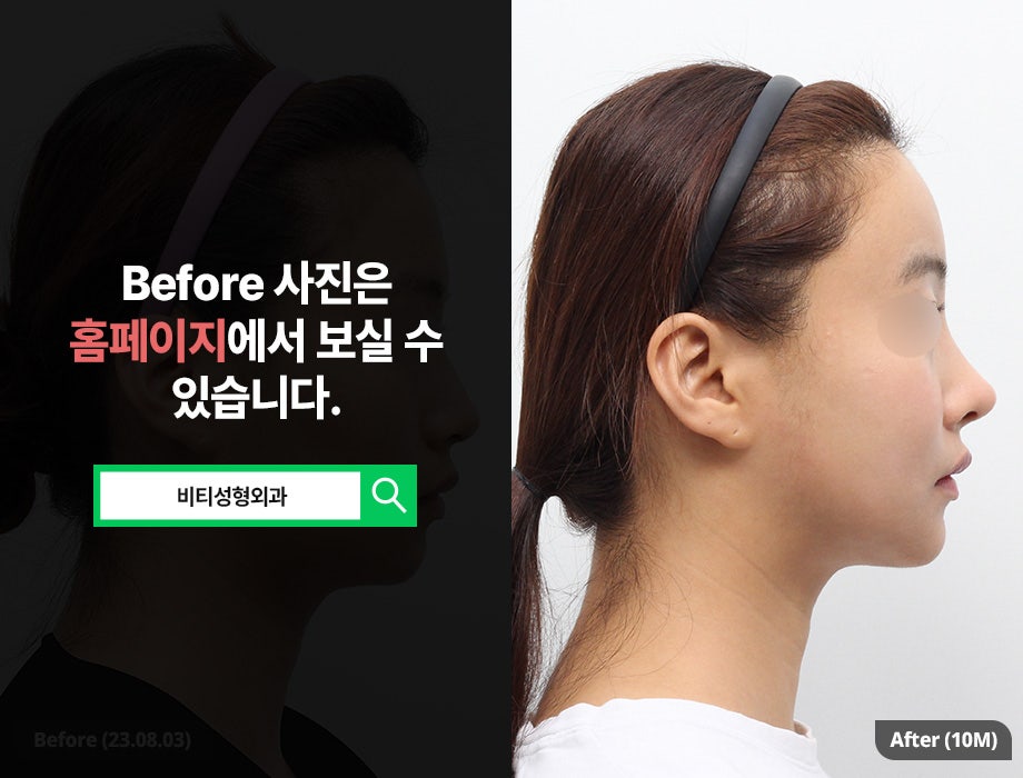 추구미에 딱 맞는 윤곽성형✨ 비티 퍼스널 안면윤곽 관련 이미지 3