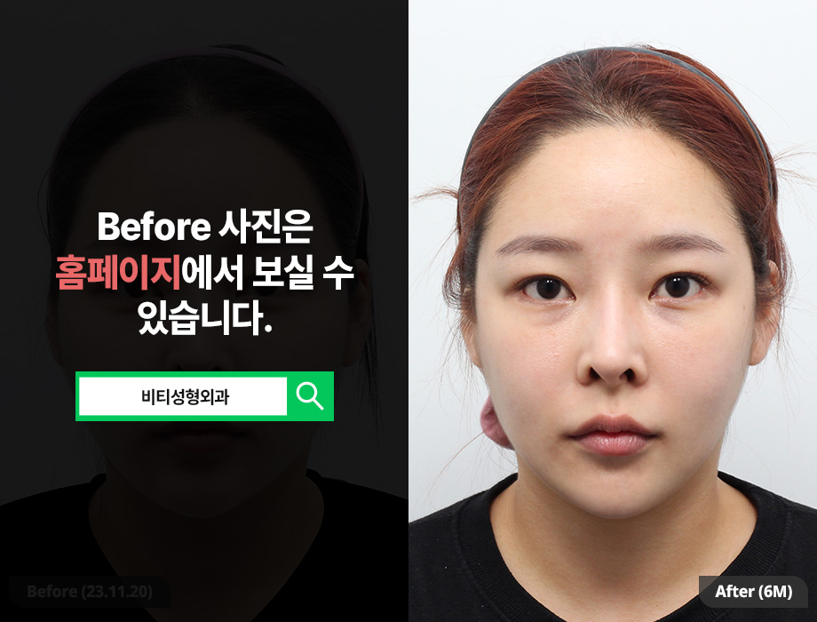 What Changes Can You Expect from Two-Procedure Facial Contouring: Cheekbone + Square Jaw? image 1