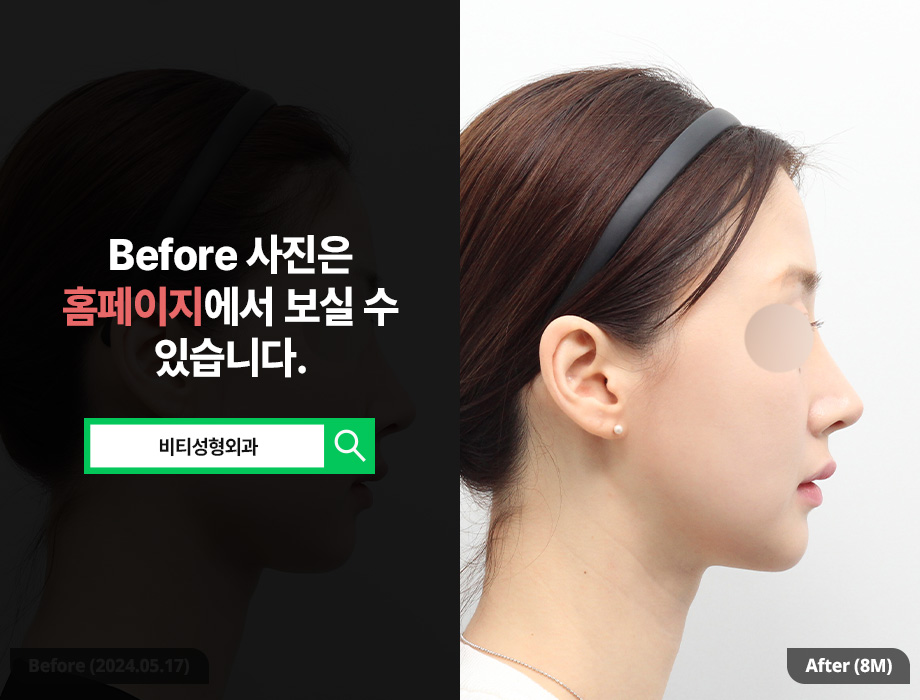 V-line Without T-Osteotomy? The Shocking Secret of Long-Curve Square Jaw Surgery image 3