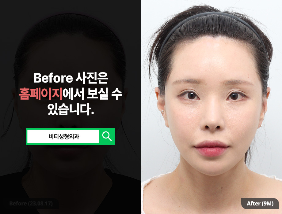 턱 여백 줄이고 작아진 얼굴! 윤곽 3종 리얼후기 관련 이미지 1