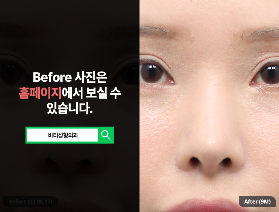 코재수술, 왜 자가늑연골을 사용할까? 관련 이미지 3