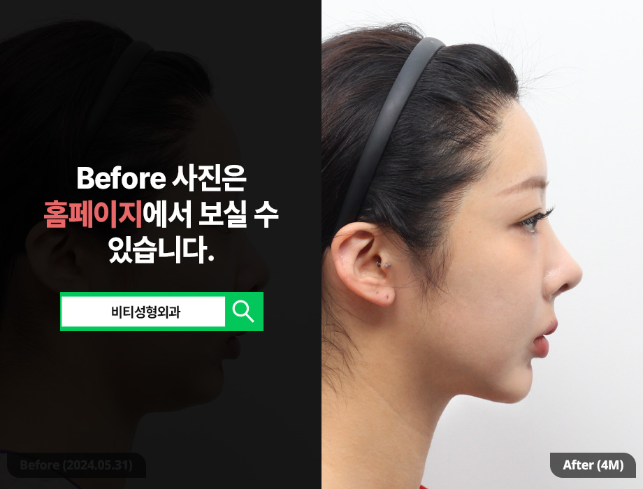 살을 빼도 턱살이 안빠져요 이중턱 근육묶기로 관련 이미지 3