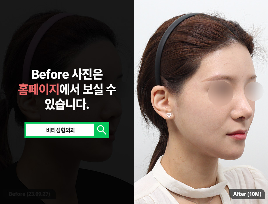 사각턱&턱끝 수술 후기｜윤곽 2종으로 갸름해진 얼굴 Before & After 관련 이미지 2