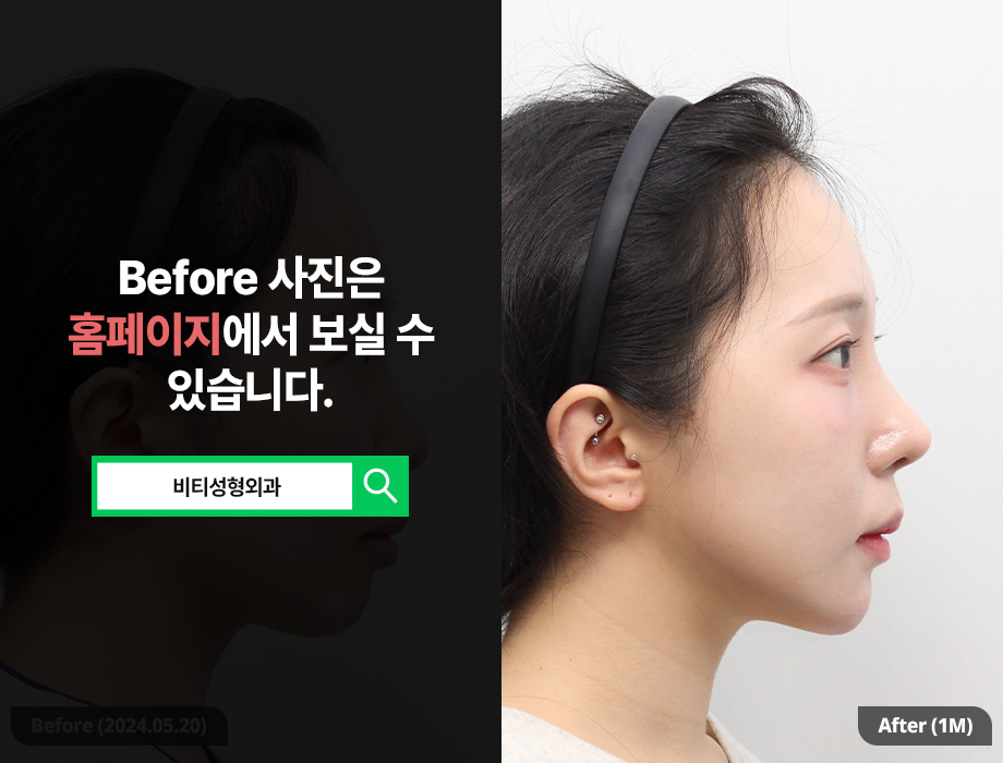 [비티성형외과] 턱끝 필러 vs 윤곽 3종, 현명한 선택 기준 & 후기 관련 이미지 3