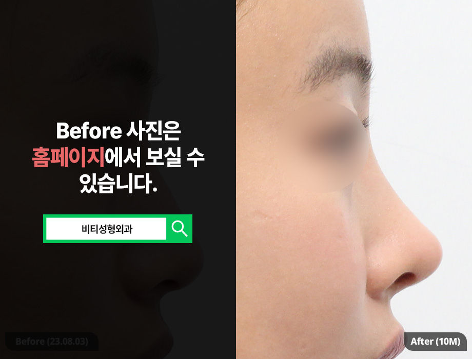 4 Reasons Why It’s Good to Bring Celebrity Photos Before Rhinoplasty image 1