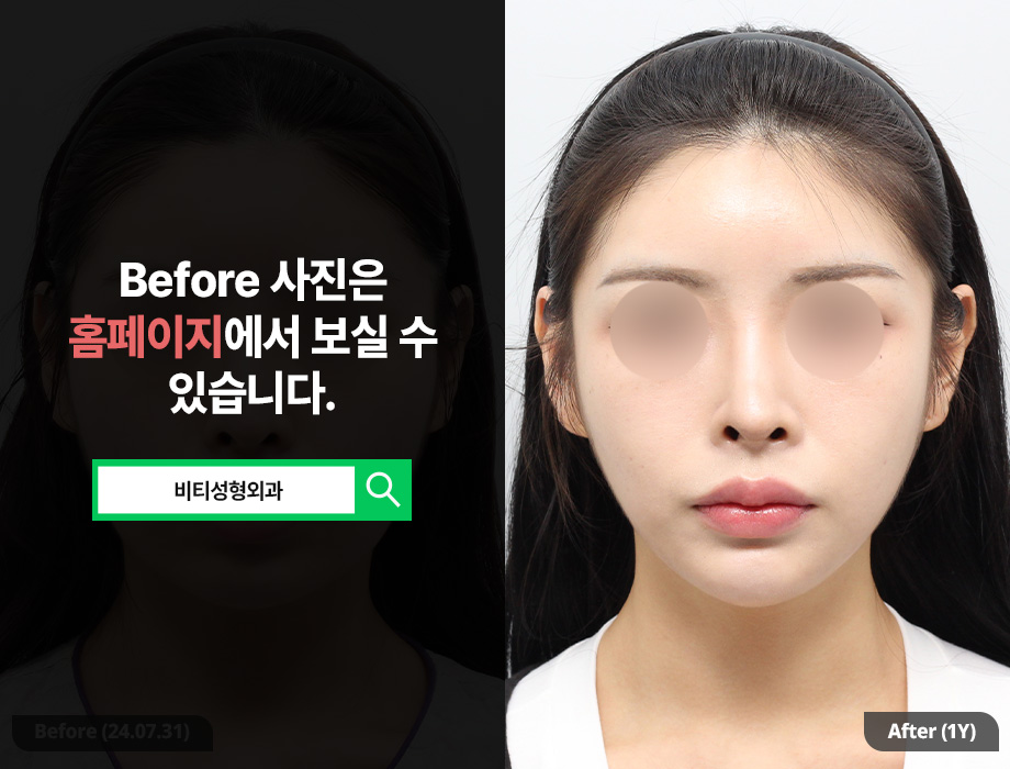Three Types of Contouring Surgery: Three Structural Reasons the Face Looks Smaller image 1