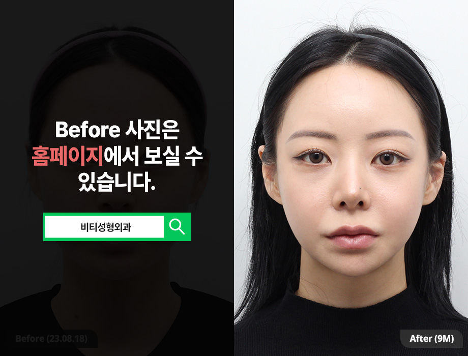 입체적인 얼굴형 만들기, 윤곽 3종 수술 전 꼭 알아야 할 것들 관련 이미지 1