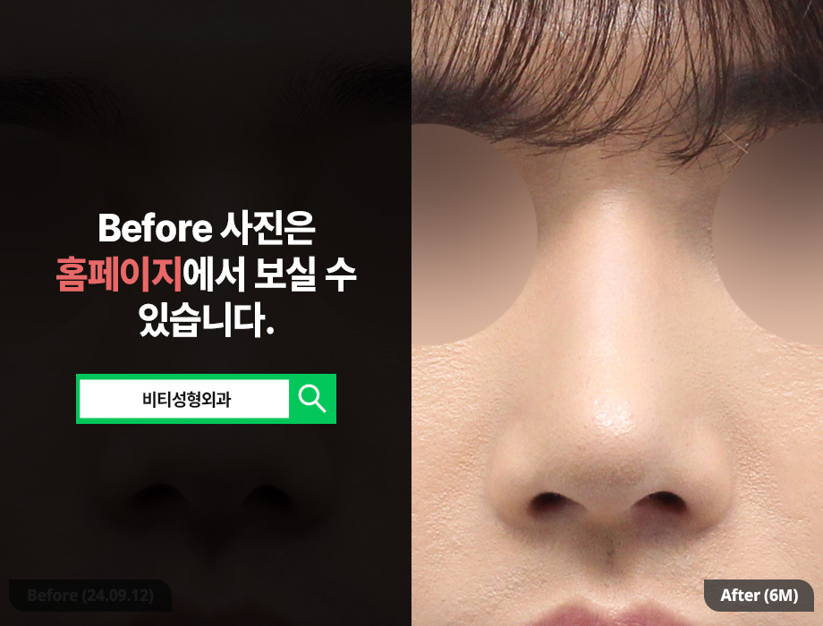 [남자 코성형] 무보형물 코성형이 뜨는이유? 관련 이미지 3