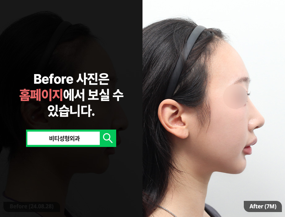 Filler Side Effect: A Receding Chin? Improved with Contouring Surgery | 7-Month Real Review image 3